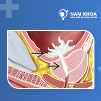 Giải pháp nào điều trị rối loạn xuất tinh