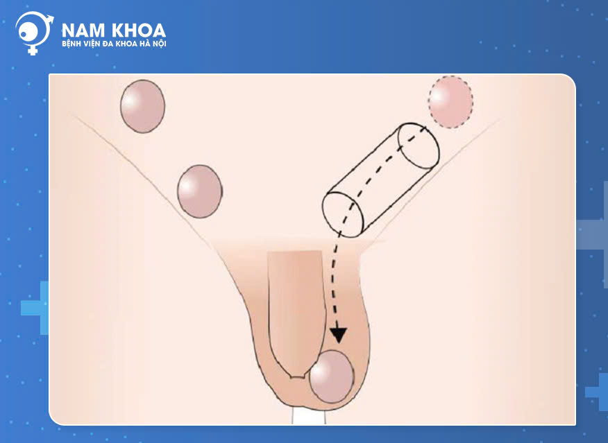 Nguyên nhân, triệu chứng và cách điều trị tinh hoàn ẩn ở trẻ nhỏ 