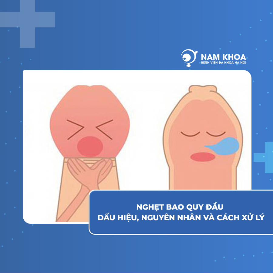 Nghẹt bao quy đầu là gì: Dấu hiệu, nguyên nhân và cách xử lý