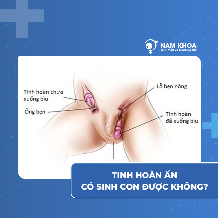 Tinh hoàn ẩn có sinh con được không ?