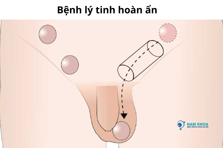 tinh hoàn ẩn có sinh con được không