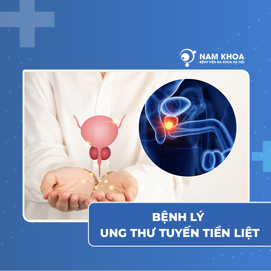 Bệnh lý ung thư tuyến tiền liệt?